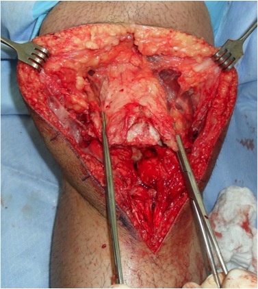 Chronic Patella Tendon Rupture 2